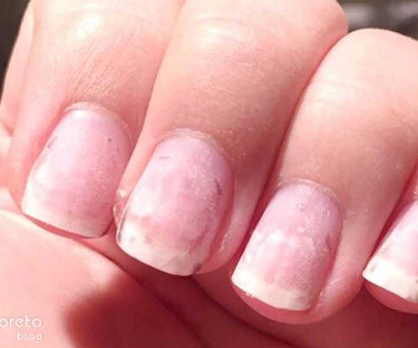 چرا کاشت ناخن هوا می‌گیرد؟ بررسی علمی + روش‌های حرفه‌ای جلوگیری از آن