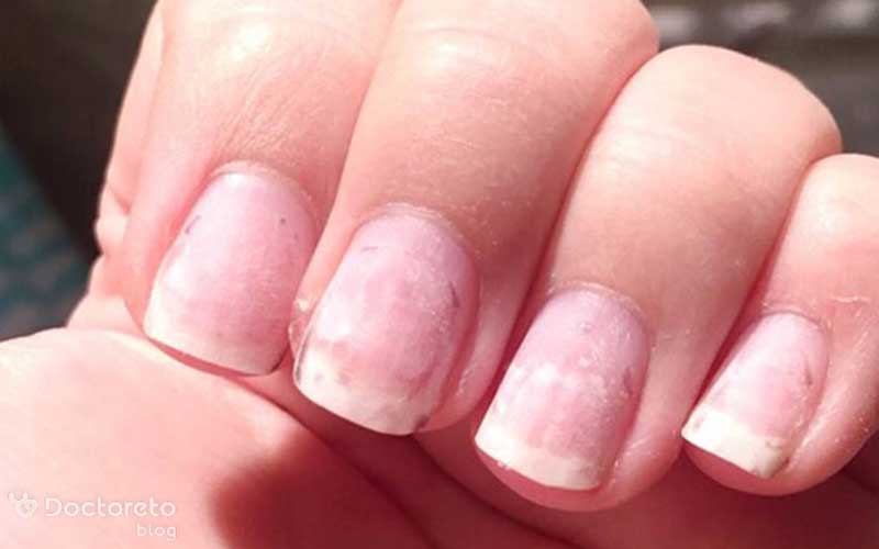 چرا کاشت ناخن هوا میگیرد؟ بررسی علمی + روشهای حرفهای جلوگیری از آن